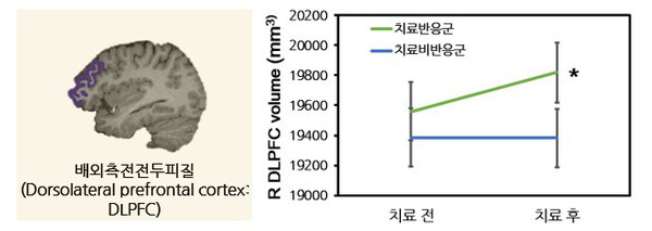 [그림1] 항우울제 치료 전후 배외측 전전두피질 부피의 변화(R=right(우측), *p<0.05로 통계적으로 유의미함)