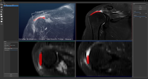  Multiplanar reformation view. 빨간색 영역은 자동으로 분할된 RCT 병변을 나타낸다. 분할된 영역은 다중면(coronal, axial, sagittal) 방향으로 자유롭게 제어해 볼 수 있다.