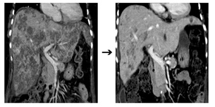 ▲왼쪽사진 : 간에 생긴 염증이 검게 찍힌 CT 영상, 오른쪽사진: 치료 후 간농양이 호전된 CT 영상.
