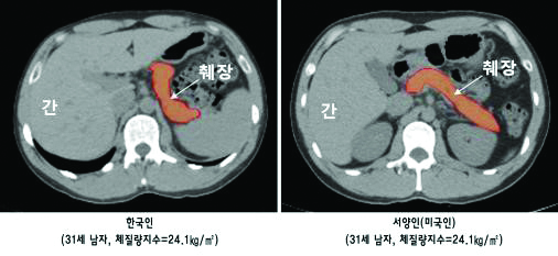 그림. 한국인과  서양인의 췌장 부피 비교