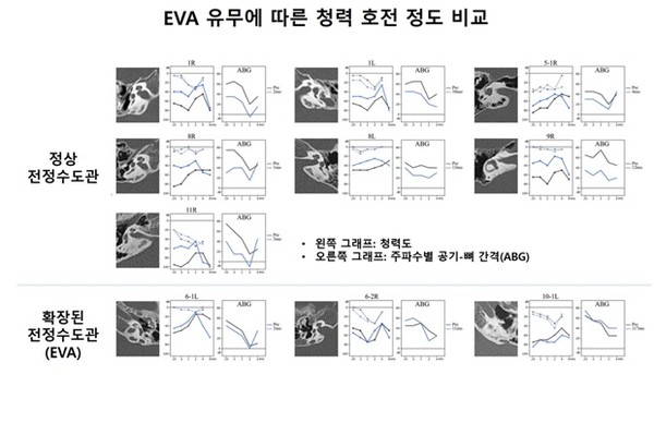 확장된 전정수도관(EVA) 유무에 따른 중이 수술 후 air-bone gap(ABG)을 통해 살펴본 청력 호전 정도에 대한 비교