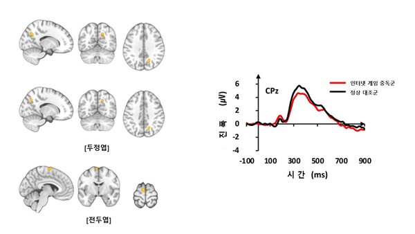 <그림 1. 기능적 MRI 검사 결과 인터넷 게임 중독군은 정상대조군들보다 두정엽과 전두엽 부위에서 뇌 활성이 증가했다(좌측 사진). 청각 자극에 대한 뇌파 신호의 진폭은 인터넷 게임 중독군이 정상대조군보다 감소했다(우측 그래프).