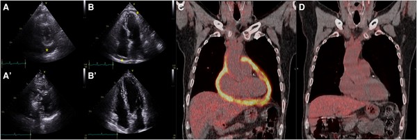 ▲서울성모병원 정미향, 오주현 교수 연구팀은 결핵성 심낭염으로 치료받는 환자의 치료 경과를 확인하고자 치료 전후의 심장초음파와 양전자단층촬영을 시행했다. - 심장초음파 : (치료 전) A, B  / (치료 후) A', B' - 양전자단층촬영 : (치료 전) C / (치료 후) D→ 치료 전 밝게 빛나던 심낭이 치료 후 인근 부위와 유사한 음영을 보이고 있다.