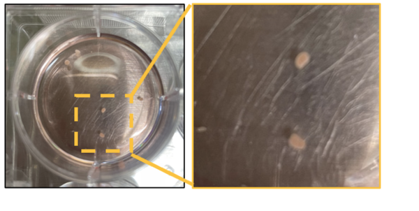 ▲뇌수막종 환자 세포 활용 오가노이드.