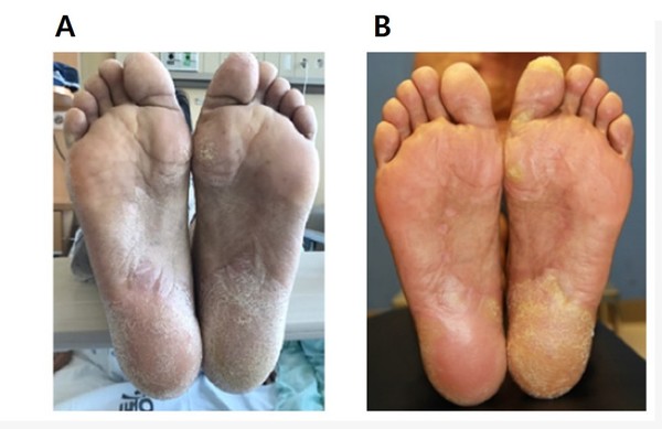 ▲그림1. 골수 유래 중간엽 줄기세포 치료 전후 동일 환자 피부 외양 변화. A : 줄기세포 치료 전, B : 줄기세포 치료 후(8주간 4회 반복 투여 후) 만성 이식편대숙주질환으로 인한 염증성 피부 병변이 감소했다.