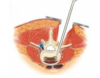 최소침습 척추경 체내 케이지 삽입술 