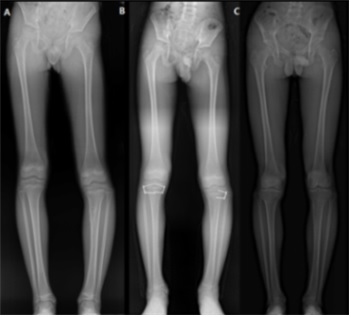 A. 왼쪽 무릎 주변에 무경성 골연골종이 발생한 환자로, 왼쪽 다리가 짧은 하지부동과 O다리 변형이 관찰된다.B. 왼쪽 무릎의 종양을 제거하는 ‘골연골종 절제술’과 ‘성장판 유합술(일시적으로 한 쪽 성장판의 기능을 억제해 환자가 성장하며 변형이 교정될 수 있도록 하는 수술법)’을 시행했다.C. 수술 후 하지 변형이 완전히 교정된 모습