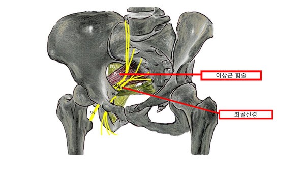 이상근 힘줄과 좌골신경 위치