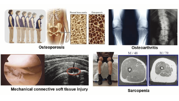 그림. 퇴행성 근골격계 질환