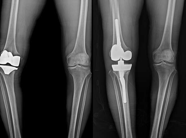 무릎 인공관절 재수술 전(좌), 후(우).