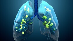 기사 제목 'COPD 환자 낮은 신체활동, 체력보다 ‘증상 인식’ 영향 더 컸다'의 대표 이미지