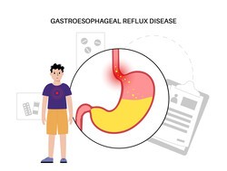 기사 제목 'AET 4% 기준 GERD 진단서 MNBI 병합 평가 필요성 제시'의 대표 이미지