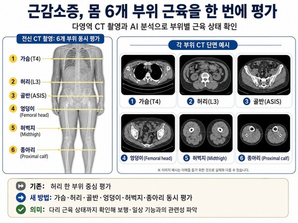 기사 제목 '고령층 근감소증, AI와 CT로 평가한다'의 대표 이미지