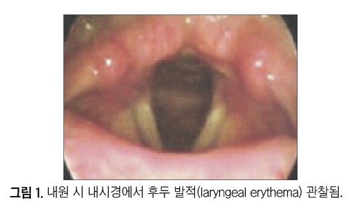 기사 제목 'PPI 치료에 충분히 반응하지 않은  인후두역류질환(LPRD) 환자에서  Esomeprazole/Calcium carbonate의 임상적 효과'의 대표 이미지