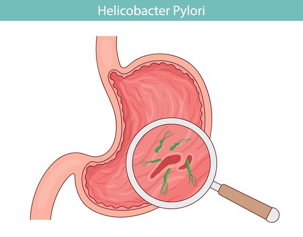 기사 제목 'H. pylori 제균치료, ‘맞춤치료·4제요법’ 중심 재편···P-CAB도 공식 반영'의 대표 이미지