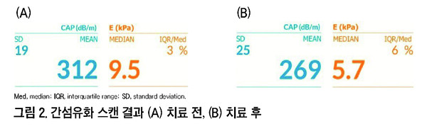 기사 제목 '수술 중 우연히 발견된 MASLD 환자에서 Carnitine-Orotate Complex 투여를 통한 지방증과 섬유화 개선 결과'의 대표 이미지